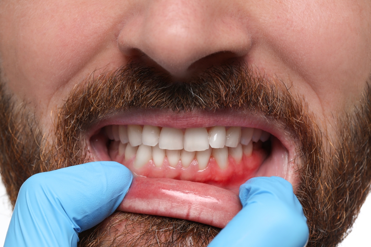 Gum Disease Treatment