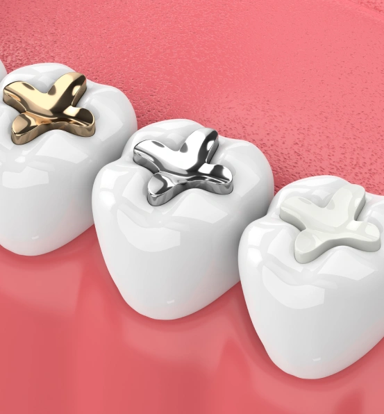 Dental Filling Procedure